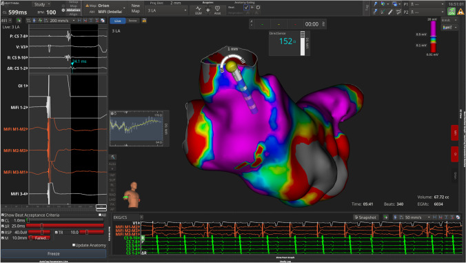 Rhythmia zero-fluoroscopy workflow with high-power, short-duration ablation: retrospective analysis of procedural data.