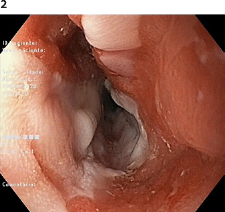 A Rare Cause of Food Impaction: Heterotopic Gastric Mucosa.