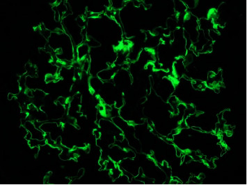 Triple Jeopardy: Rapidly Progressive Glomerulonephritis Induced by Triple Seropositive Disease-A Rare Case.