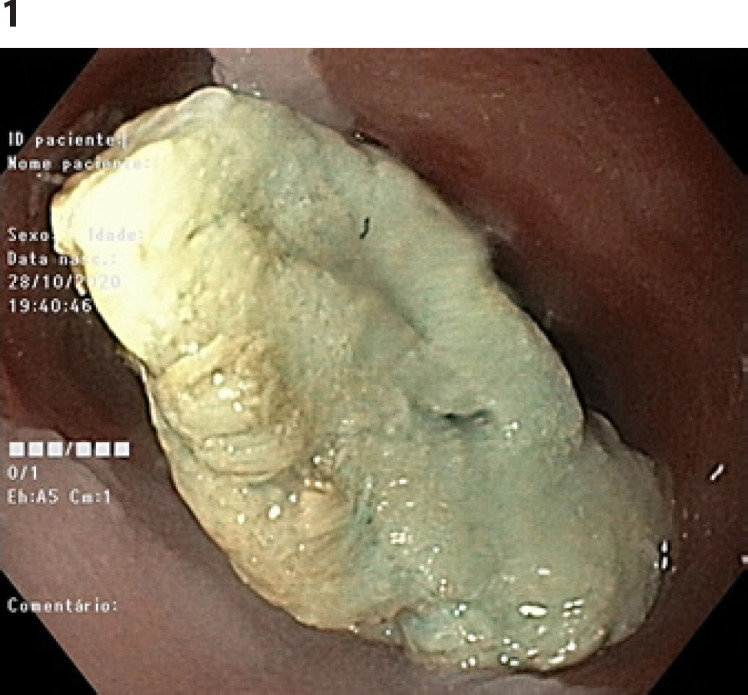 A Rare Cause of Food Impaction: Heterotopic Gastric Mucosa.