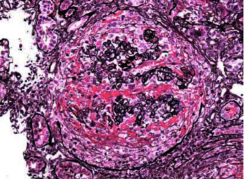 Triple Jeopardy: Rapidly Progressive Glomerulonephritis Induced by Triple Seropositive Disease-A Rare Case.