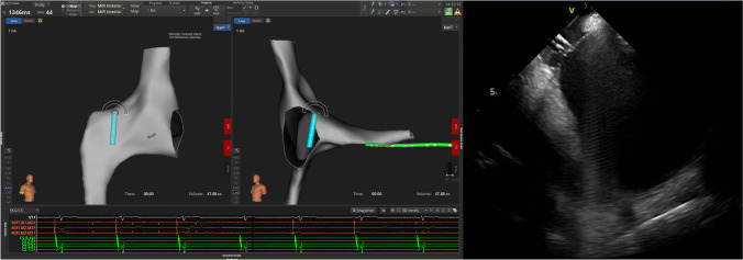 Rhythmia zero-fluoroscopy workflow with high-power, short-duration ablation: retrospective analysis of procedural data.