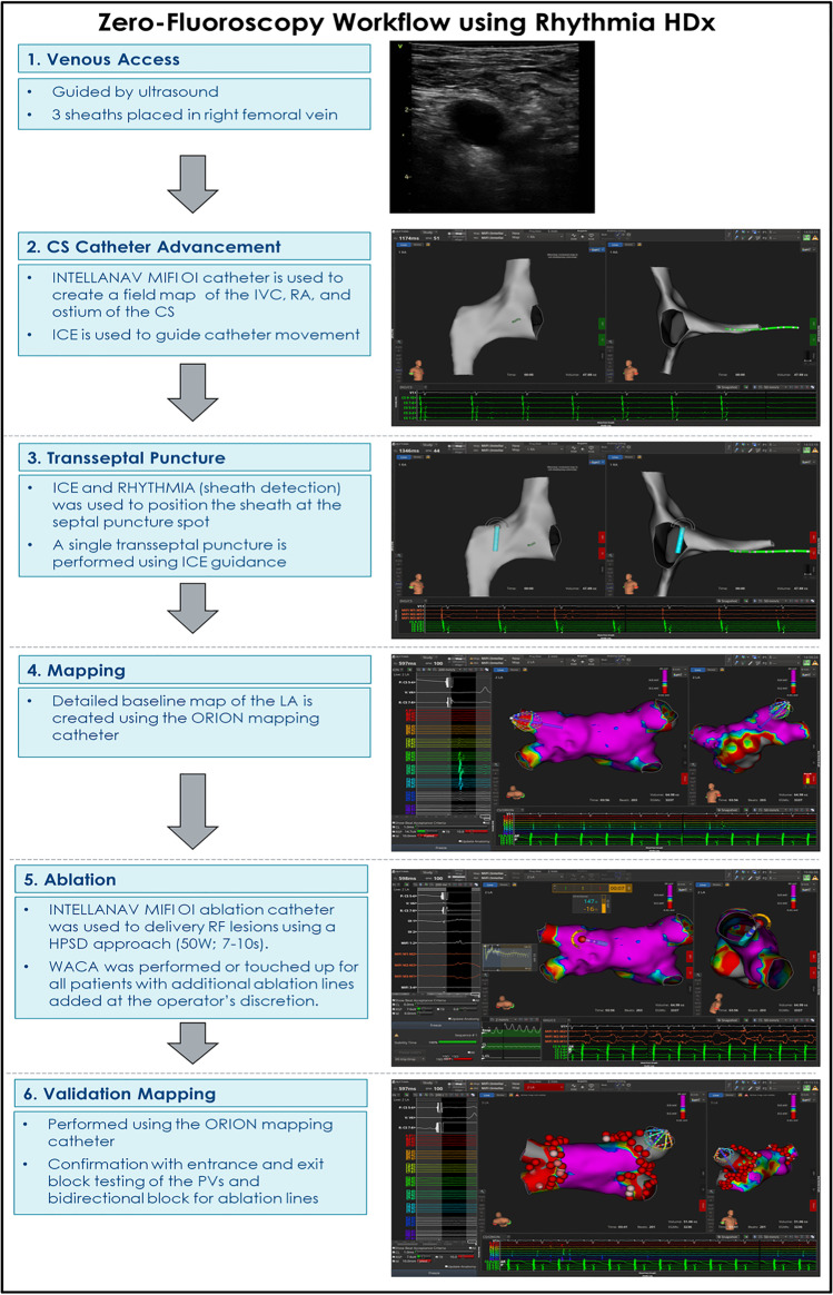 Rhythmia zero-fluoroscopy workflow with high-power, short-duration ablation: retrospective analysis of procedural data.