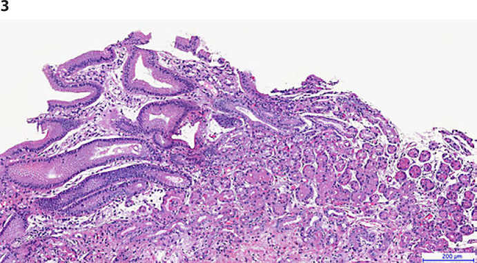 A Rare Cause of Food Impaction: Heterotopic Gastric Mucosa.