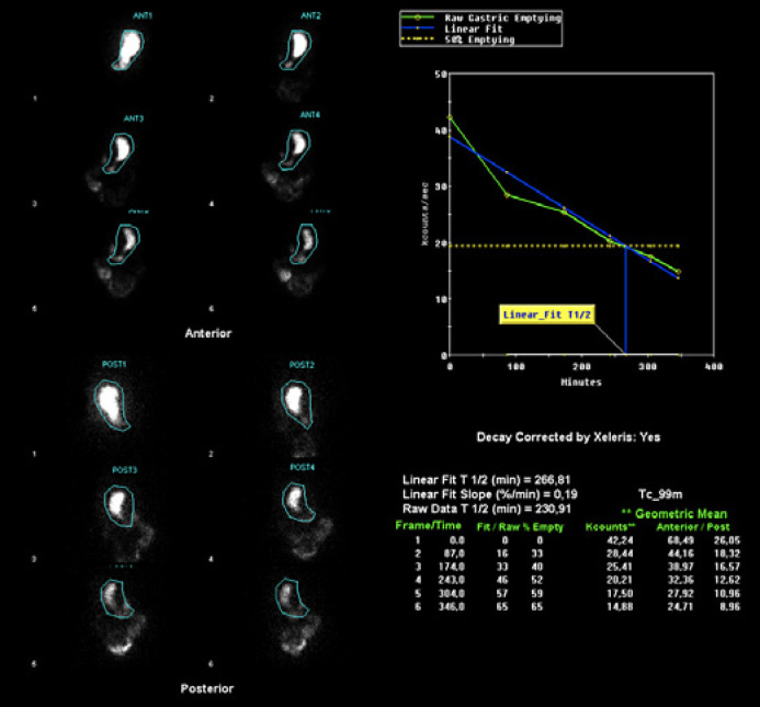 Gastric Peroral Endoscopic Myotomy as a Therapeutic Option in Refractory Gastroparesis: A Step-By-Step Description.