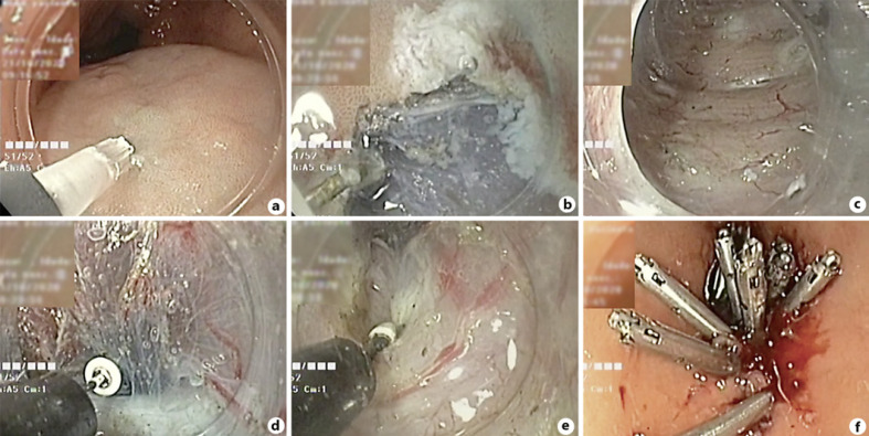 Gastric Peroral Endoscopic Myotomy as a Therapeutic Option in Refractory Gastroparesis: A Step-By-Step Description.