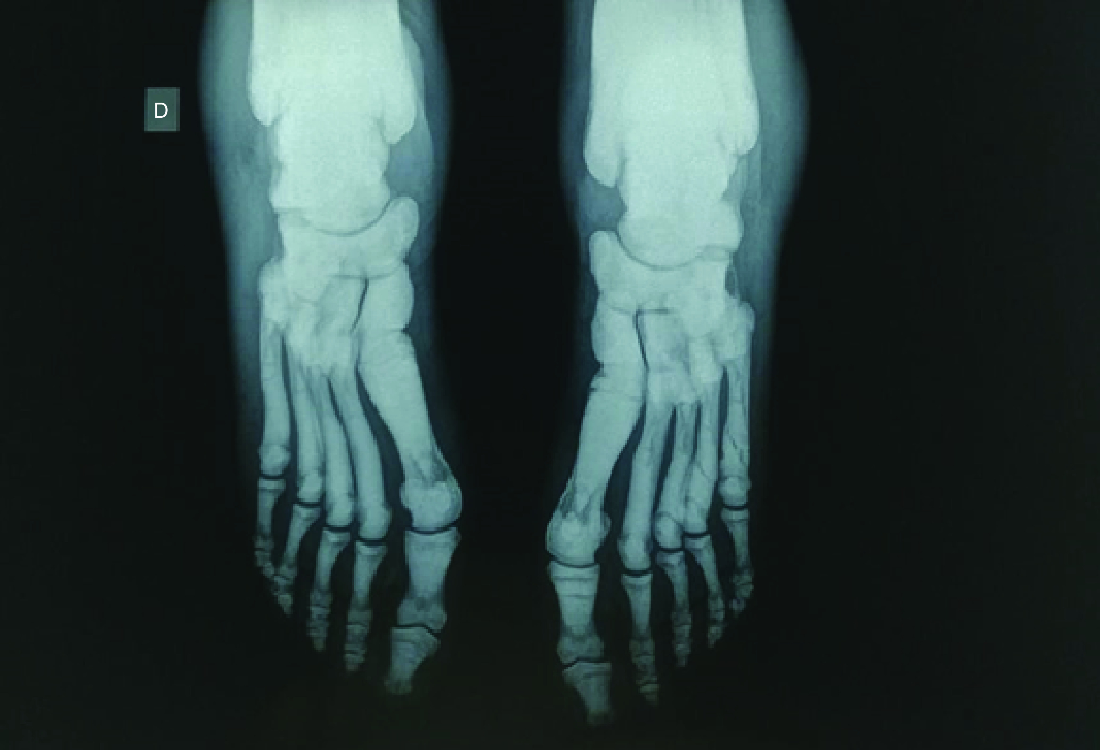 Osteopetrosis: a rare case of portal hypertension.