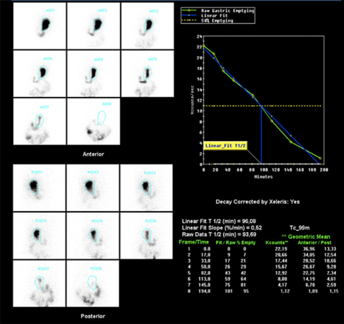 Gastric Peroral Endoscopic Myotomy as a Therapeutic Option in Refractory Gastroparesis: A Step-By-Step Description.