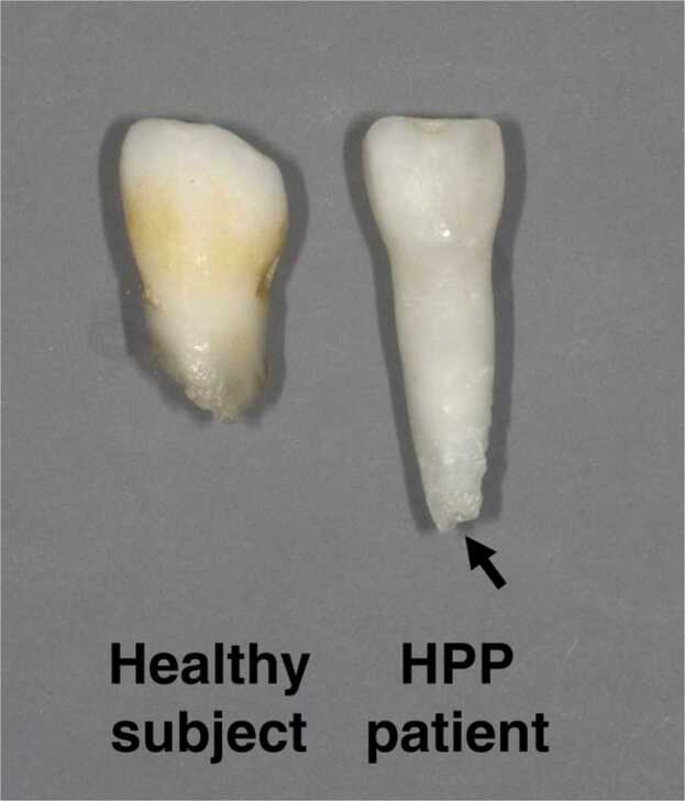 Dental manifestation and management of hypophosphatasia