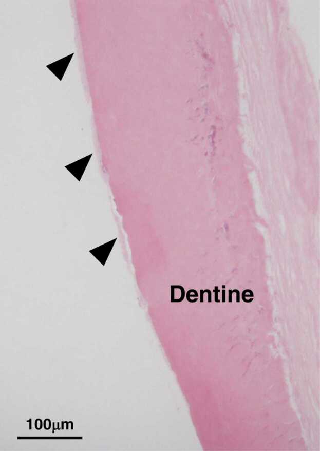 Dental manifestation and management of hypophosphatasia