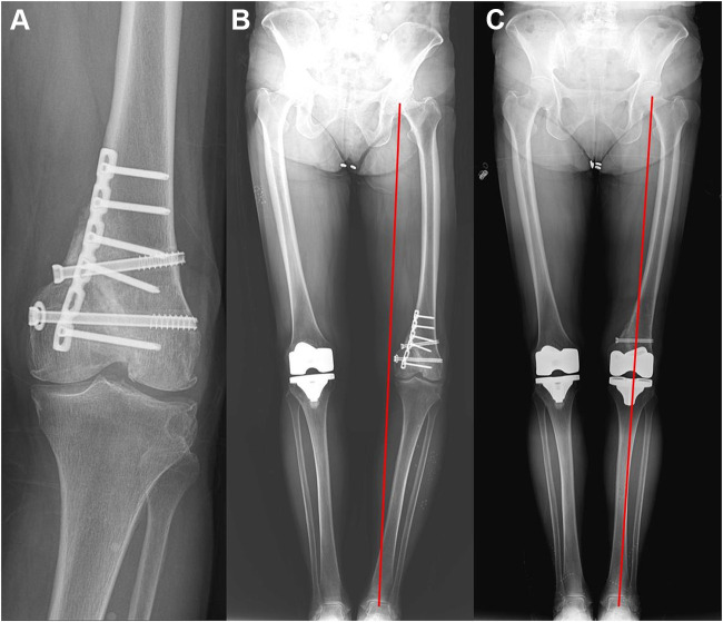Coronal Correction for Post-Traumatic Malalignment Using Robot-Assisted Total Knee Arthroplasty: A Case Series.
