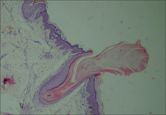 Ichthyosis Follicularis with Alopecia and Photophobia Syndrome with Coexisting Palmoplantar Keratoderma Treated with Acitretin.