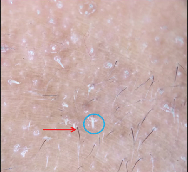 Ichthyosis Follicularis with Alopecia and Photophobia Syndrome with Coexisting Palmoplantar Keratoderma Treated with Acitretin.