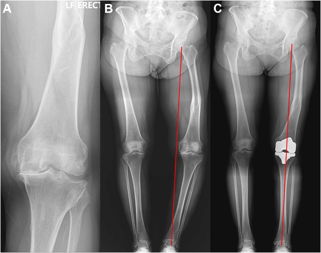 Coronal Correction for Post-Traumatic Malalignment Using Robot-Assisted Total Knee Arthroplasty: A Case Series.