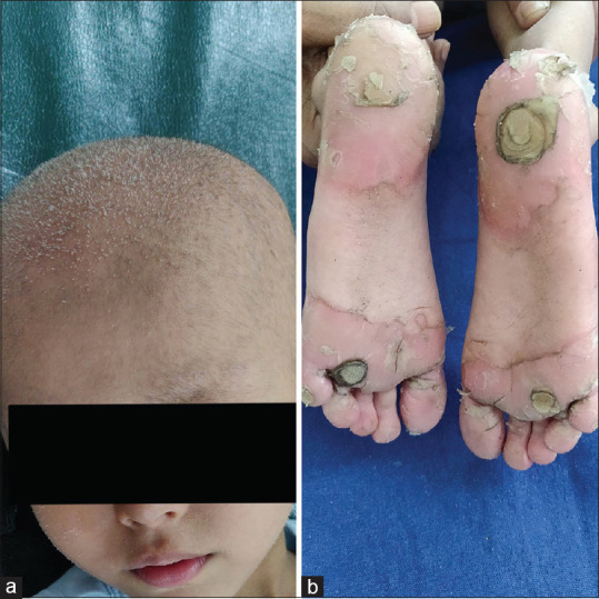 Ichthyosis Follicularis with Alopecia and Photophobia Syndrome with Coexisting Palmoplantar Keratoderma Treated with Acitretin.