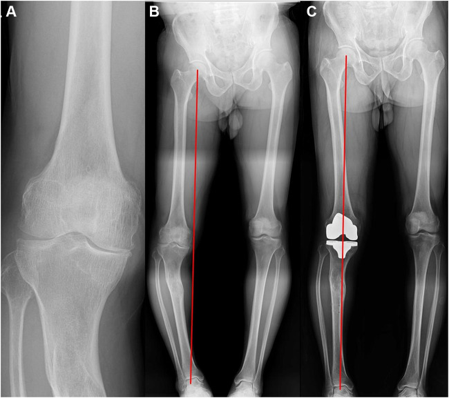 Coronal Correction for Post-Traumatic Malalignment Using Robot-Assisted Total Knee Arthroplasty: A Case Series.