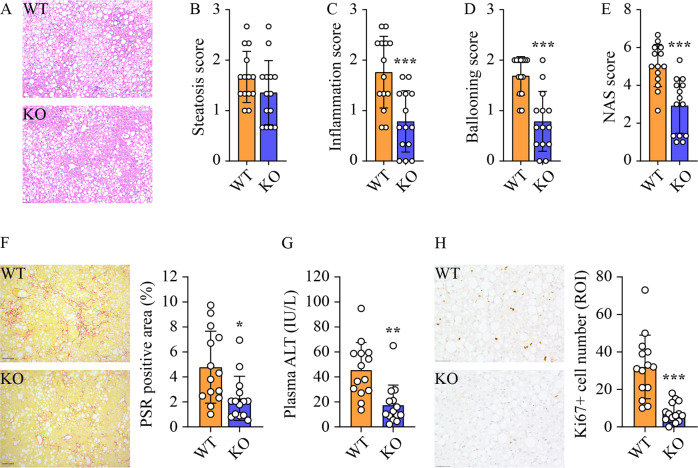 Ablation of sphingosine kinase 2 suppresses fatty liver-associated hepatocellular carcinoma via downregulation of ceramide transfer protein.