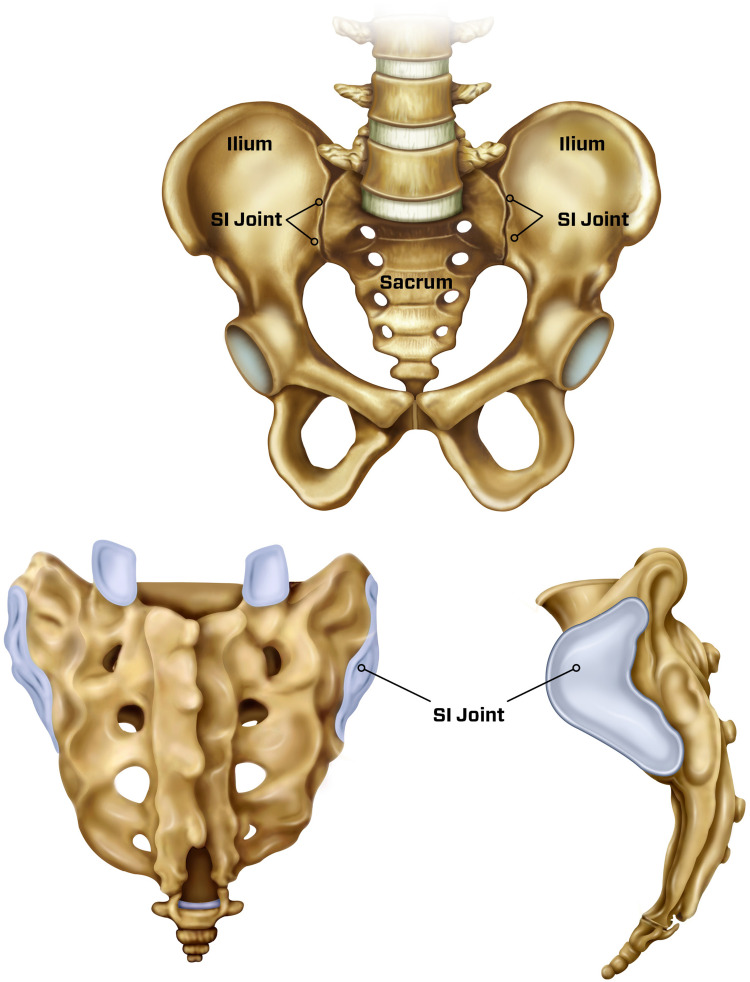 Minimally Invasive Inferior Intra-Articular Sacroiliac Joint Fusion: Successful Application of Osseous Stabilization Using Allograft Bone.