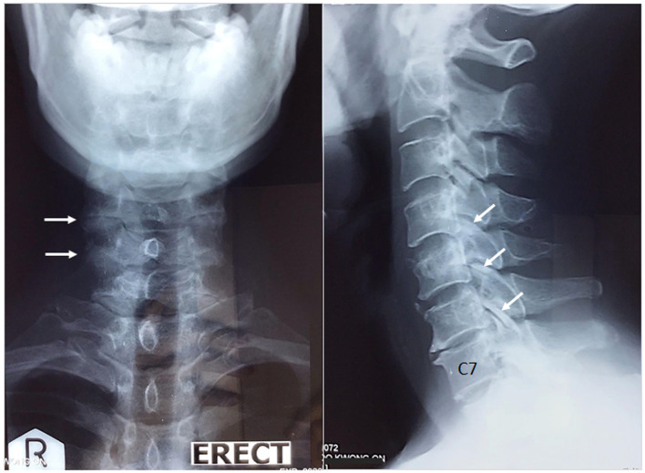 Cervical Radiculopathy as a Hidden Cause of Angina: Cervicogenic Angina.