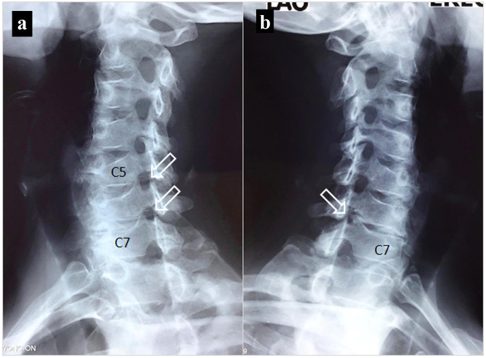 Cervical Radiculopathy as a Hidden Cause of Angina: Cervicogenic Angina.