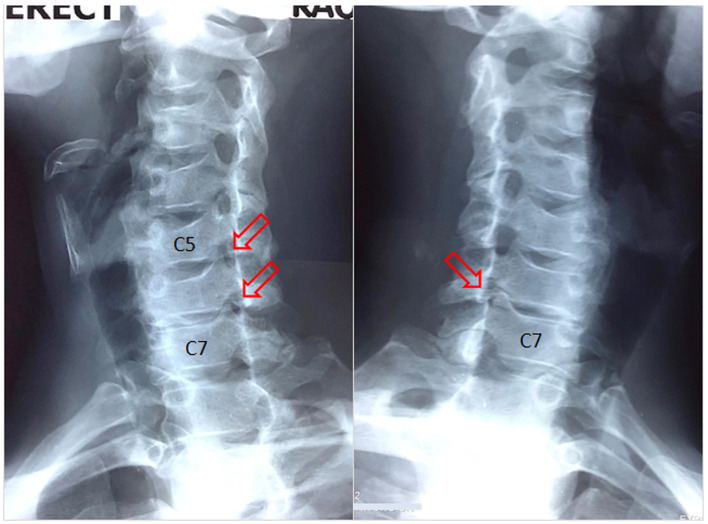 Cervical Radiculopathy as a Hidden Cause of Angina: Cervicogenic Angina.