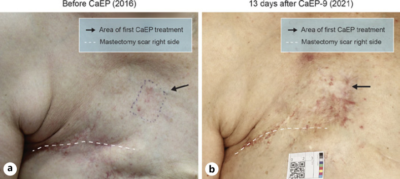 Calcium Electroporation for Management of Cutaneous Metastases in HER2-Positive Breast Cancer: A Case Report.