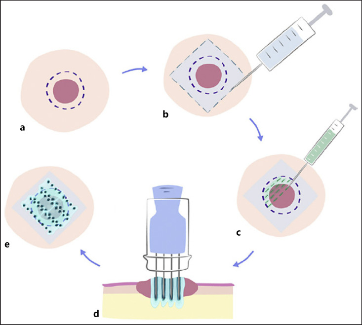 Calcium Electroporation for Management of Cutaneous Metastases in HER2-Positive Breast Cancer: A Case Report.