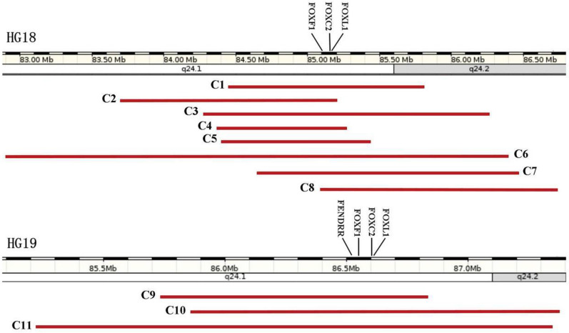 Haploinsufficiencies of FOXF1, FOXC2 and FOXL1 genes originated from deleted 16q24.1q24.2 fragment related with alveolar capillary dysplasia with misalignment of pulmonary veins and lymphedema-distichiasis syndrome: relationship to phenotype.