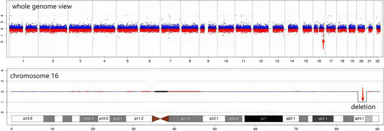 Haploinsufficiencies of FOXF1, FOXC2 and FOXL1 genes originated from deleted 16q24.1q24.2 fragment related with alveolar capillary dysplasia with misalignment of pulmonary veins and lymphedema-distichiasis syndrome: relationship to phenotype.