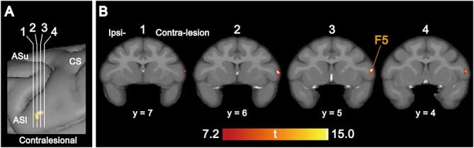 Structural plasticity of motor cortices assessed by voxel-based morphometry and immunohistochemical analysis following internal capsular infarcts in macaque monkeys.