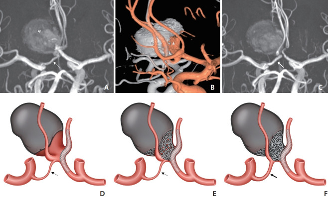 Physiologic Flow Diversion Coiling Technique for Wide-Necked Aneurysms with an Asymmetric Bidirectional Flow at the Aneurysm Neck.