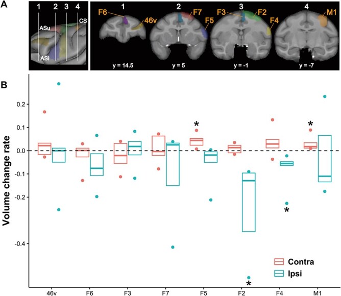 Structural plasticity of motor cortices assessed by voxel-based morphometry and immunohistochemical analysis following internal capsular infarcts in macaque monkeys.