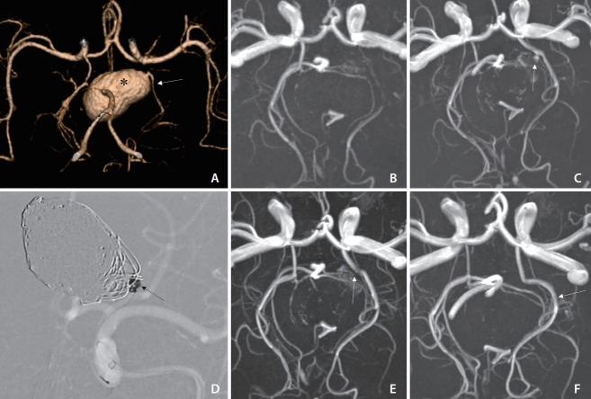 Physiologic Flow Diversion Coiling Technique for Wide-Necked Aneurysms with an Asymmetric Bidirectional Flow at the Aneurysm Neck.