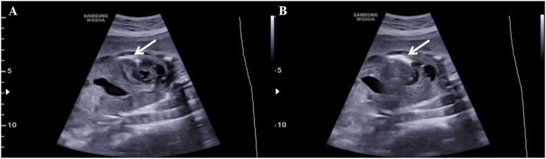 Valvuloplasty of fetal pulmonary atresia with intact ventricular septum and hypoplastic right heart: Mid-term follow-up results