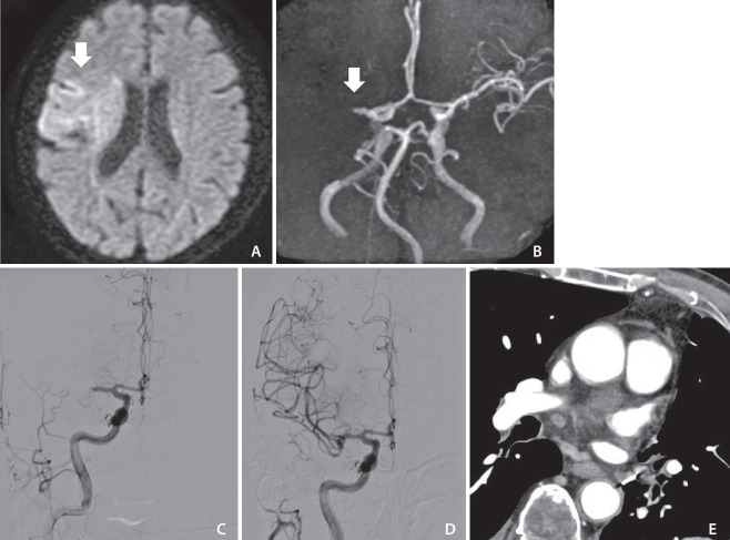 Mechanical Thrombectomy for Acute Ischemic Stroke due to Thrombus in the Pulmonary Vein Stump after Left Pulmonary Lobectomy: A Case Series.