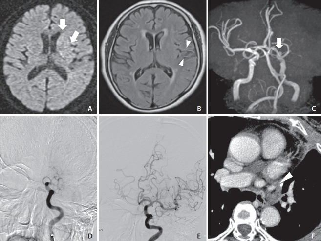 Mechanical Thrombectomy for Acute Ischemic Stroke due to Thrombus in the Pulmonary Vein Stump after Left Pulmonary Lobectomy: A Case Series.