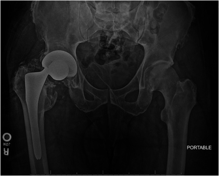 Catastrophic Trunnion Failure in an Anatomic Titanium Alloy Stem.