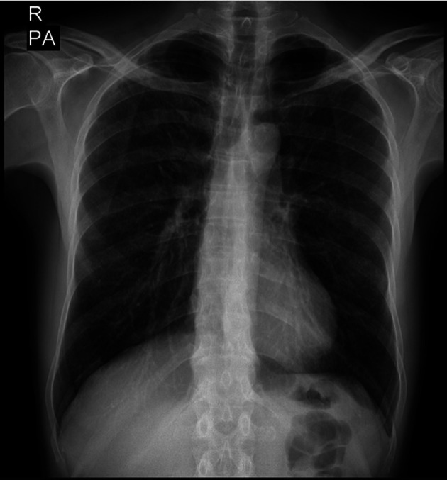 Radiological Findings in the Case Exposed to Zirconium.