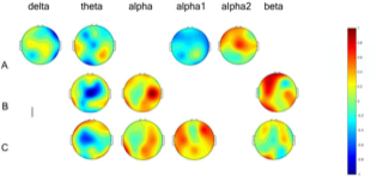 Brain Functional Correlates of Intelligence Score in ADHD Based on EEG.