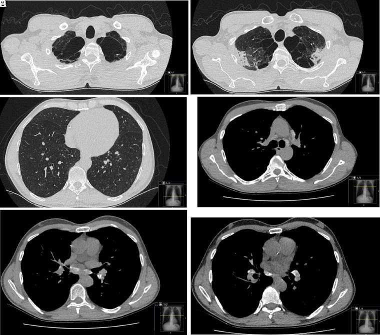 Radiological Findings in the Case Exposed to Zirconium.