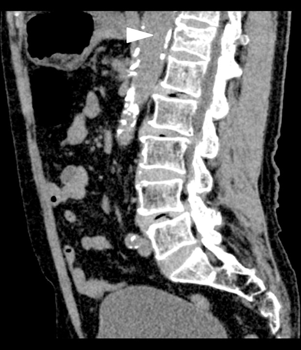 Unexplained Abdominal Pain Caused by Fracture of the Thoracic Vertebra.