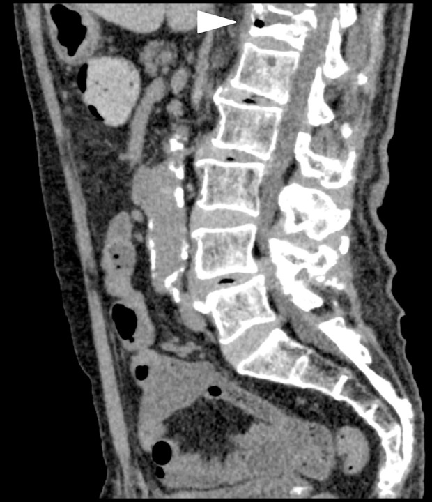 Unexplained Abdominal Pain Caused by Fracture of the Thoracic Vertebra.