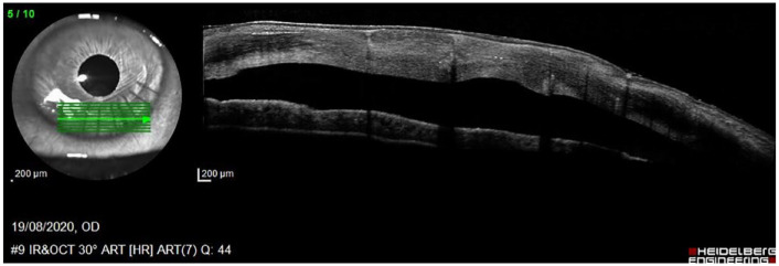 Baricitinib in severe and refractory peripheral ulcerative keratitis: a case report and literature review.