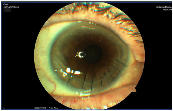 Baricitinib in severe and refractory peripheral ulcerative keratitis: a case report and literature review.