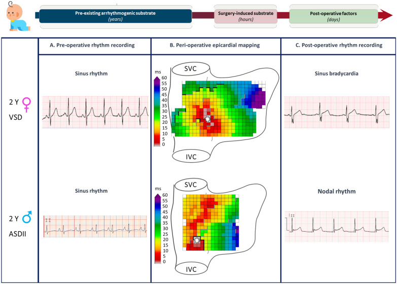 Unravelling early sinus node dysfunction after pediatric cardiac surgery: a pre-existing arrhythmogenic substrate.