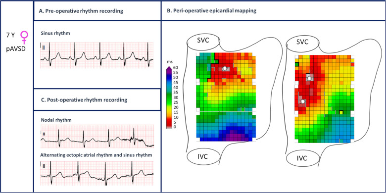 Unravelling early sinus node dysfunction after pediatric cardiac surgery: a pre-existing arrhythmogenic substrate.