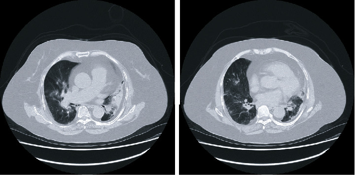 Successful Management of Coronavirus Disease 2019-Related Respiratory Failure Using High-Flow Nasal Cannula Therapy in a Patient with Underlying Pulmonary Artery Hypertension.