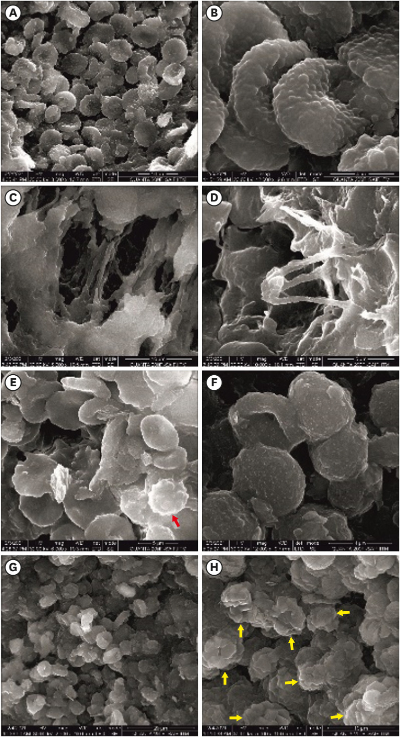 The influence of sodium hypochlorite concentration on the fibrin structure of human blood clots and transforming growth factor-beta 1 release: an <i>ex vivo</i> study.