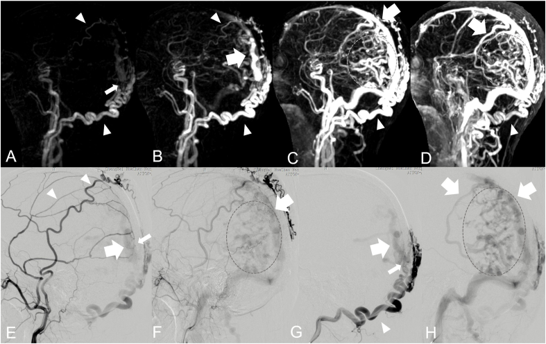 Overview of multimodal MRI of intracranial Dural arteriovenous fistulas