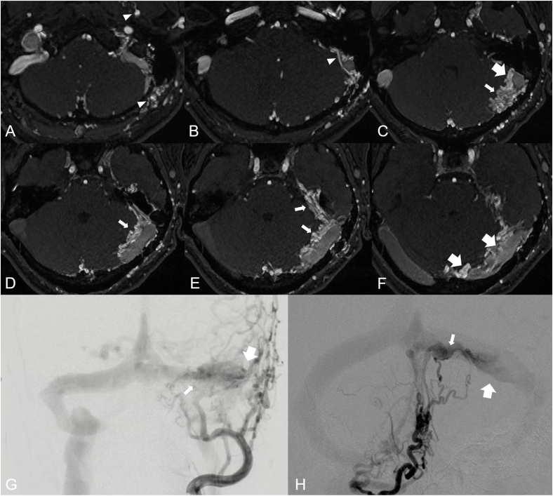 Overview of multimodal MRI of intracranial Dural arteriovenous fistulas